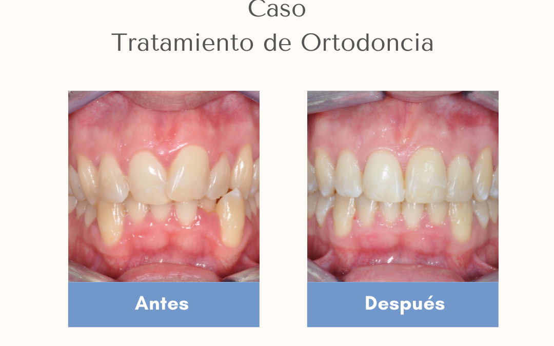 Casos de Ortodoncia Invisible