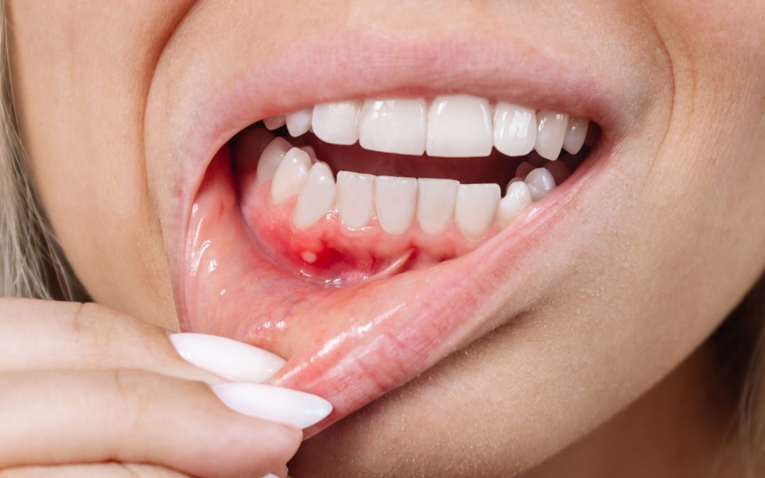 ¿Qué son las bolsas periodontales?