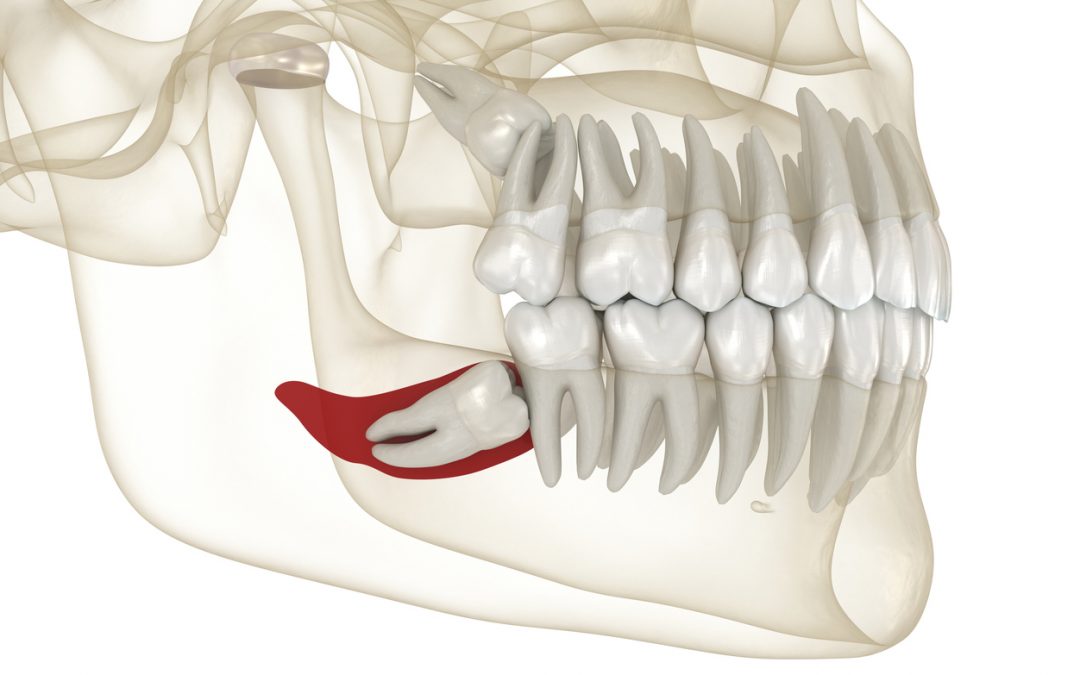 Cuidados tras una cirugía de extracción de muelas del juicio