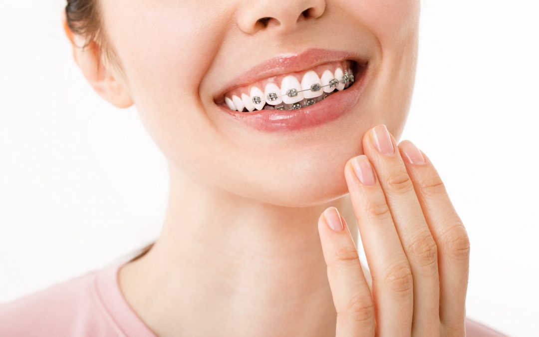 Hábitos que pueden dañar tus brackets