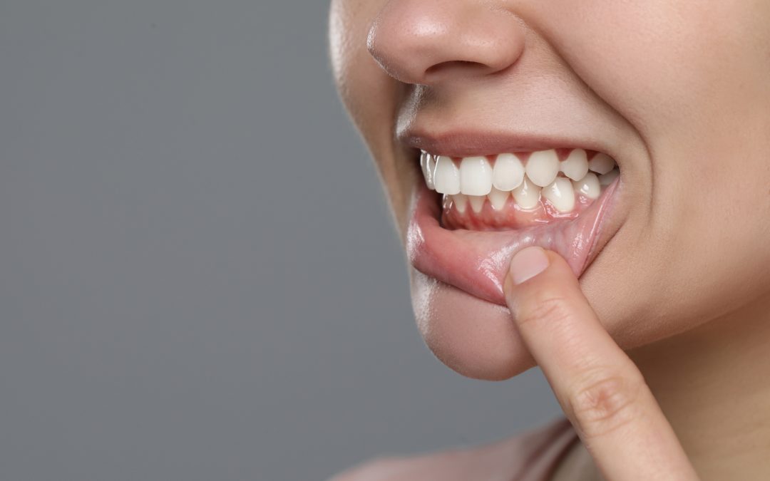 Señales de enfermedad periodontal que no debes ignorar